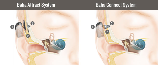 Baha® kemik iletimli implantlar